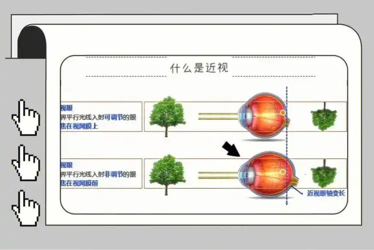 请看图11566如图92所见,近视眼轴拉长,成像在视网膜前,导致屈光