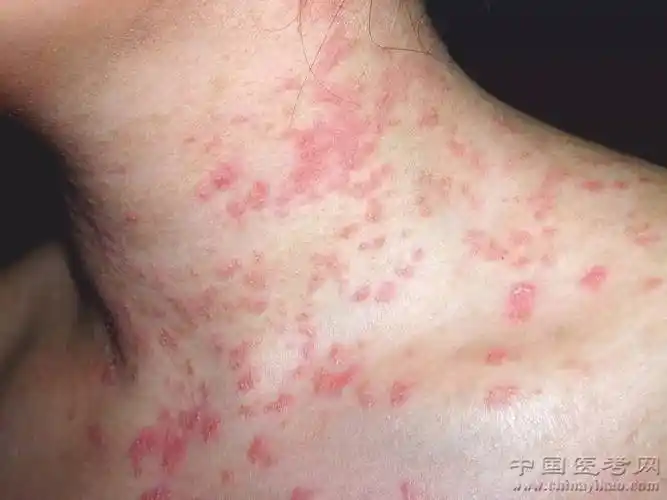 密集恐惧症及非医护人员慎点!史上最全的皮肤病图谱来了(修订版)!