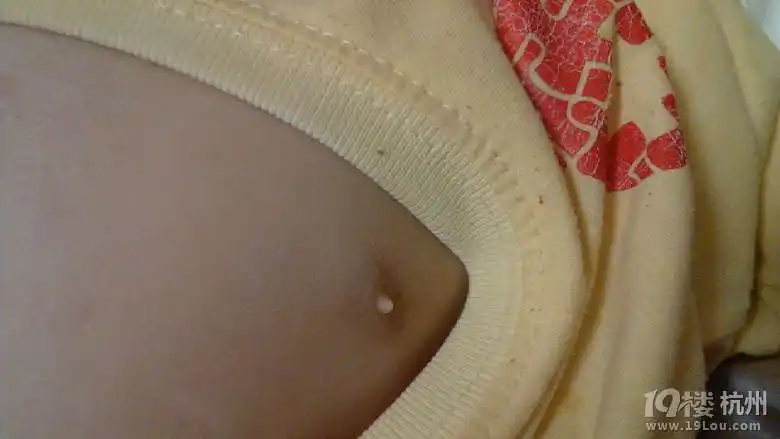 10个月男宝宝乳头是否发育了