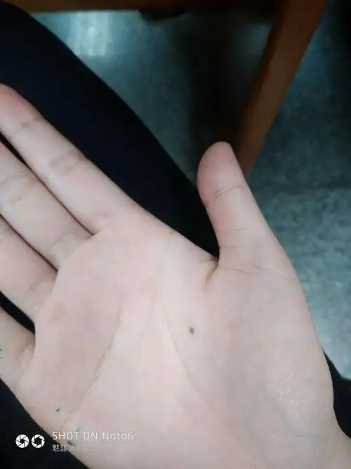 小时候手掌长了个痣,很多年了,请问有没有人知道这个有发展为黑色素瘤