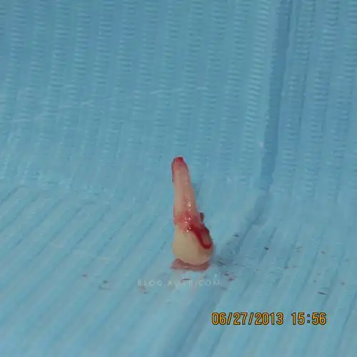 上颌第一双尖牙3牙根--屈晓兵