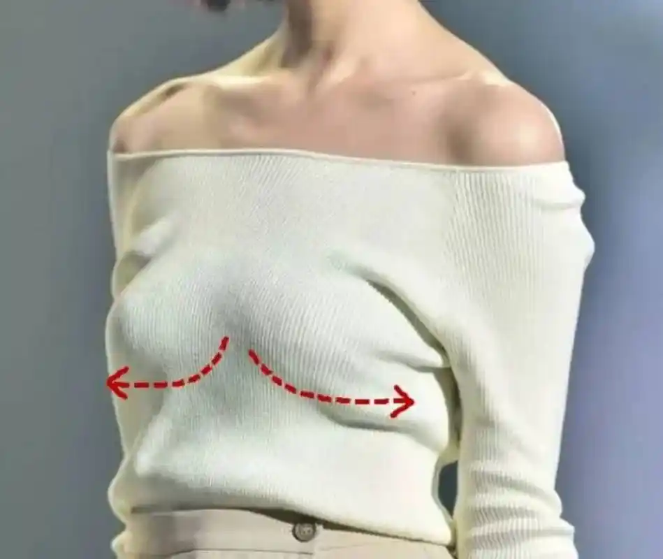 如果外侧凹陷会导致乳房形态呈扁平状或不对称,影响视觉上的饱满与