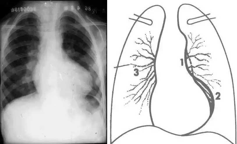 二尖瓣形(或称梨形)心脏增大分型2监护使用生命支持设备及心血管