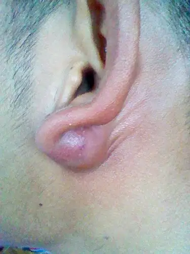 耳朵上有个大包 是怎么回事