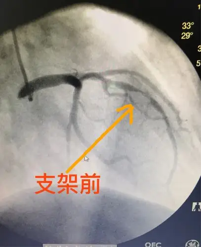 支架置入前前降支病变处!