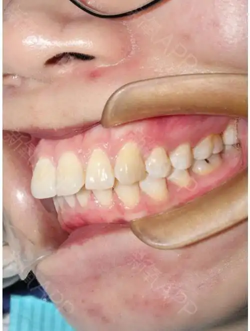 我的牙齿最明显的问题就是上排牙往外凸,所以就连嘴巴_圈子-新氧美容