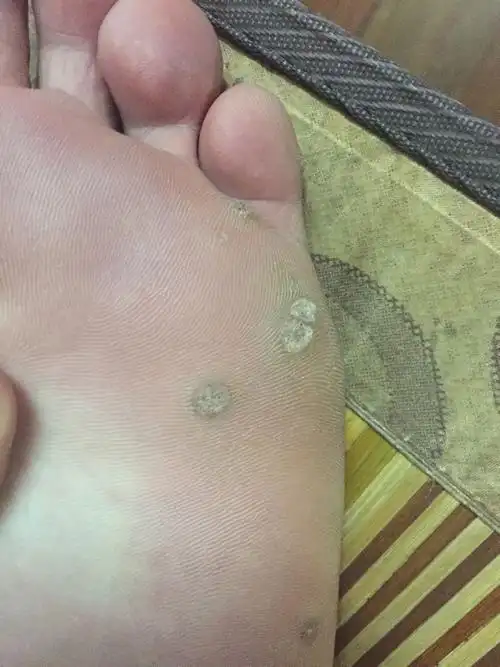 脚上长了这样的肉刺很多.左脚有,右脚没有.这是啥病啊.