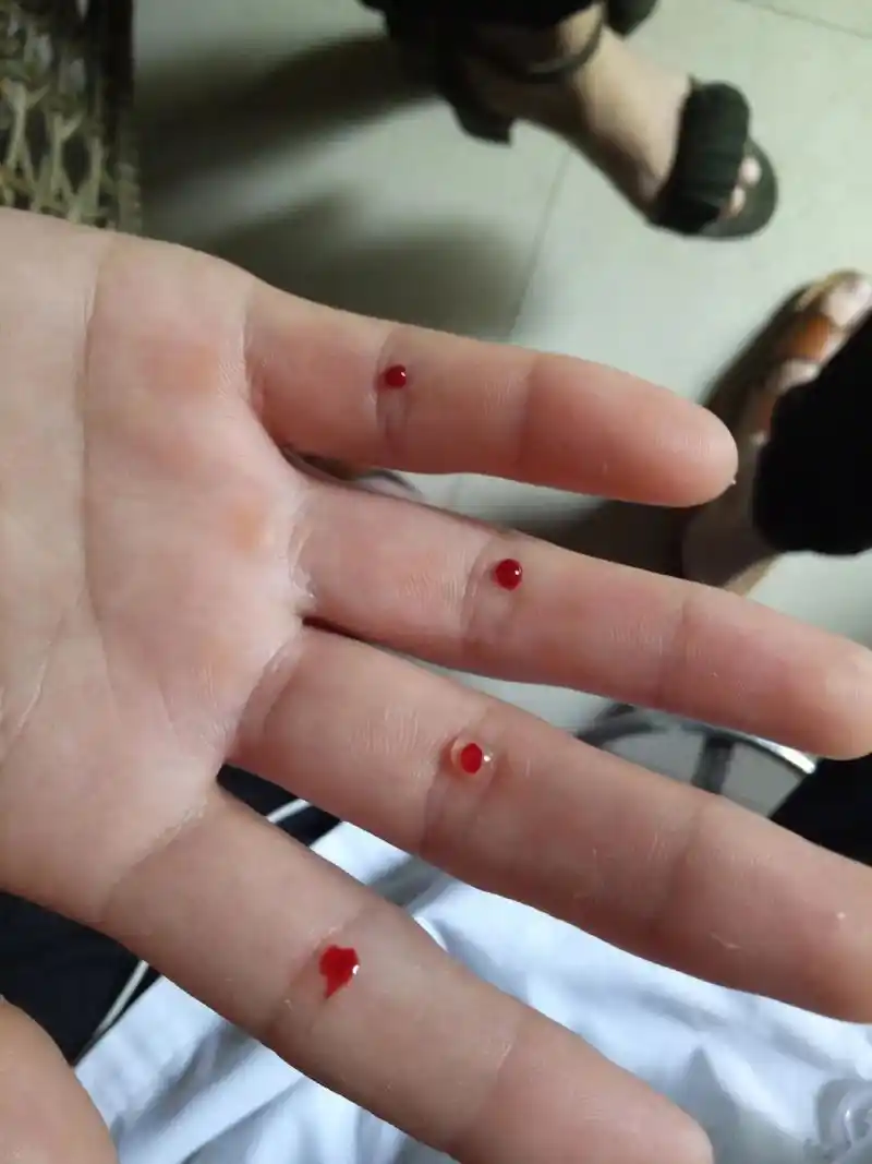 小帅哥小美女都来扎四缝放血 四缝穴放血的作用一般是治疗小孩疳 - 抖