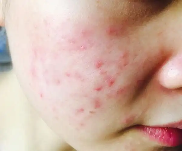 闭口?丘疹? 一直在发,好了又发. 用什么产品好? 怎么治?