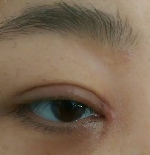 双眼皮开眼角二十五天 十几天后眼角出现白色凸起状的东西 是增生?