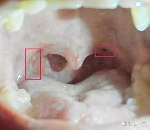 经分扁桃体切除术前后记录