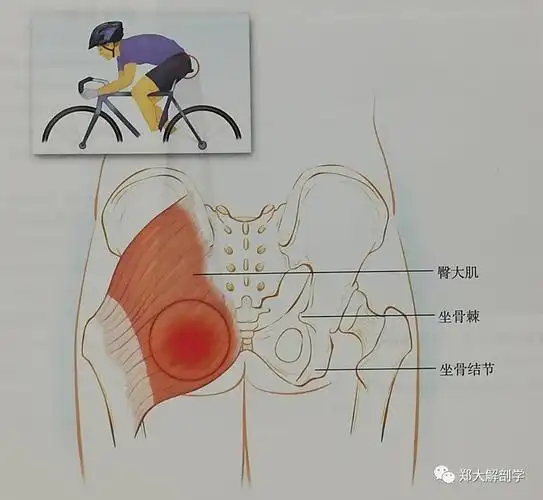 坐骨滑囊容易受到急性创伤和反复微创伤.