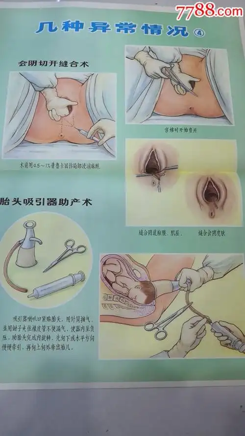 七十年代:新法接生挂图(一套20张)