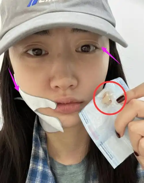 景甜拔智齿整张脸肿起来素颜曝脸上胎记五官像极赵露思