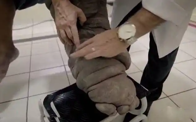 巴西男子患象皮病 腿部肿胀似象腿