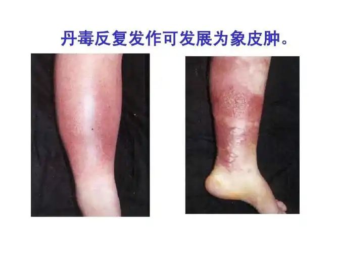 丹毒反复发作可发展为象皮肿.