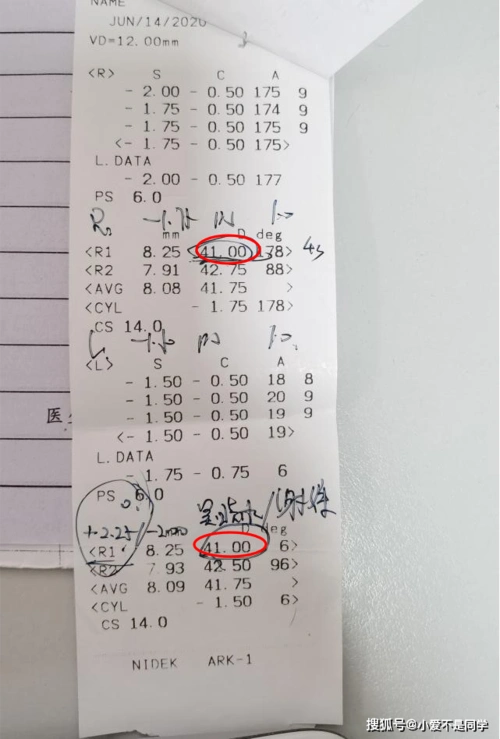 正常的角膜曲率约为43d,而婷婷的角膜曲率为41d