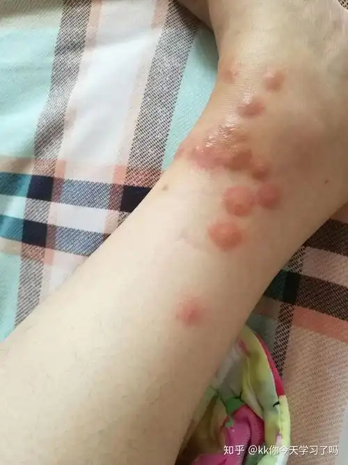 被跳蚤咬的家都不想住了,有什么办法灭了它们? - 知乎