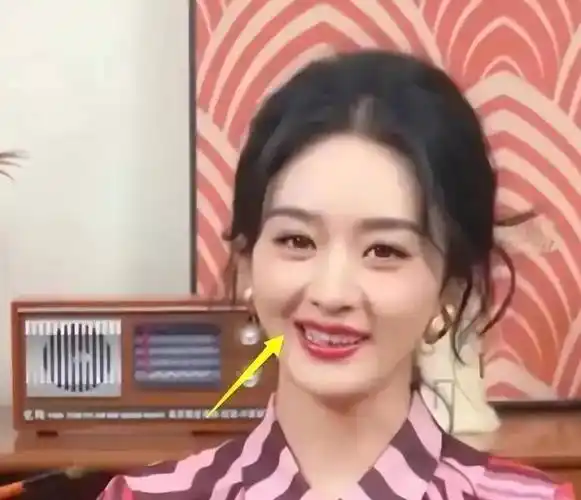 35岁的赵丽颖被网友质疑整容,有医美后遗症,表情僵硬 果子肌突出_图片