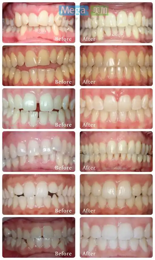 美加隐形矫正前后对比图