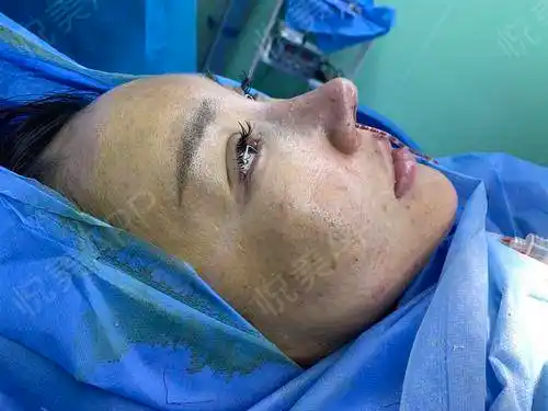 一直都觉得自己的鼻子不好看,之前也打过几次玻尿酸,...鼻小柱延长_悦