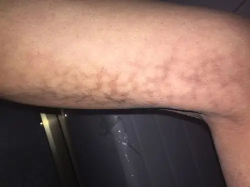 皮肤突然有一部分变黑一块,位于大腿内侧,没注意看这两天偶然看到的