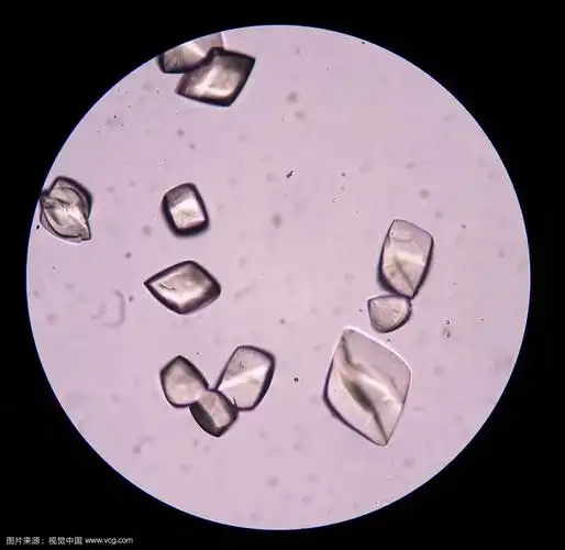 尿沉淀物中的尿酸结晶.