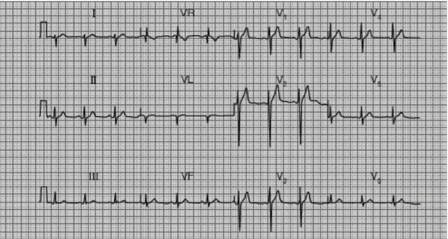 窦性心动过速 窦性心动过速是指成年人窦性心率超过100次/分,常见于