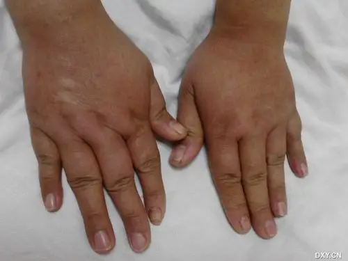 【病例讨论】象皮肿 [病例帖]