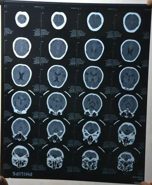 脑ct医保 医保脑ct