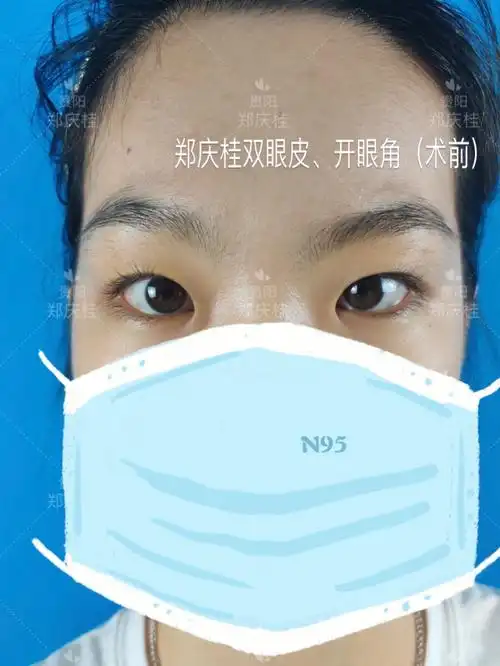 严重内眦赘皮双眼皮开眼角2个月对比