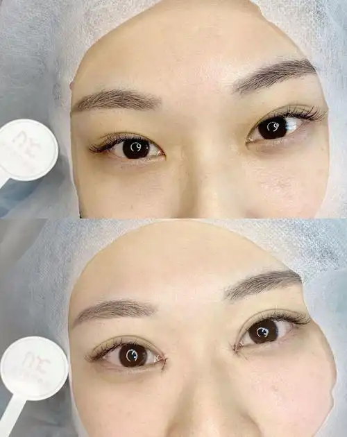 无痕双眼皮开眼角的即刻效果