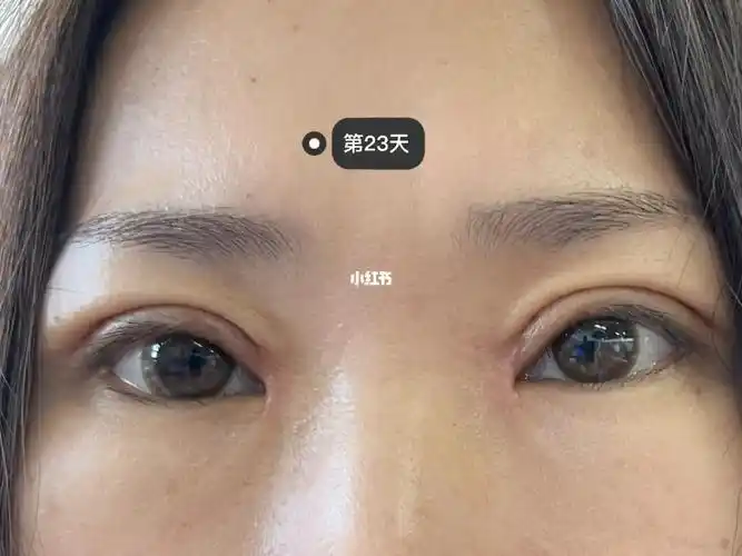 全切双眼皮77开眼角 失败了_全切双眼皮_双眼皮手术_开眼角_双眼皮