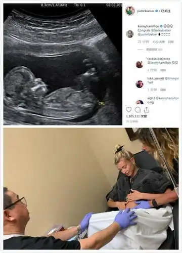 比伯宣布海莉已怀孕晒b超照自曝真相