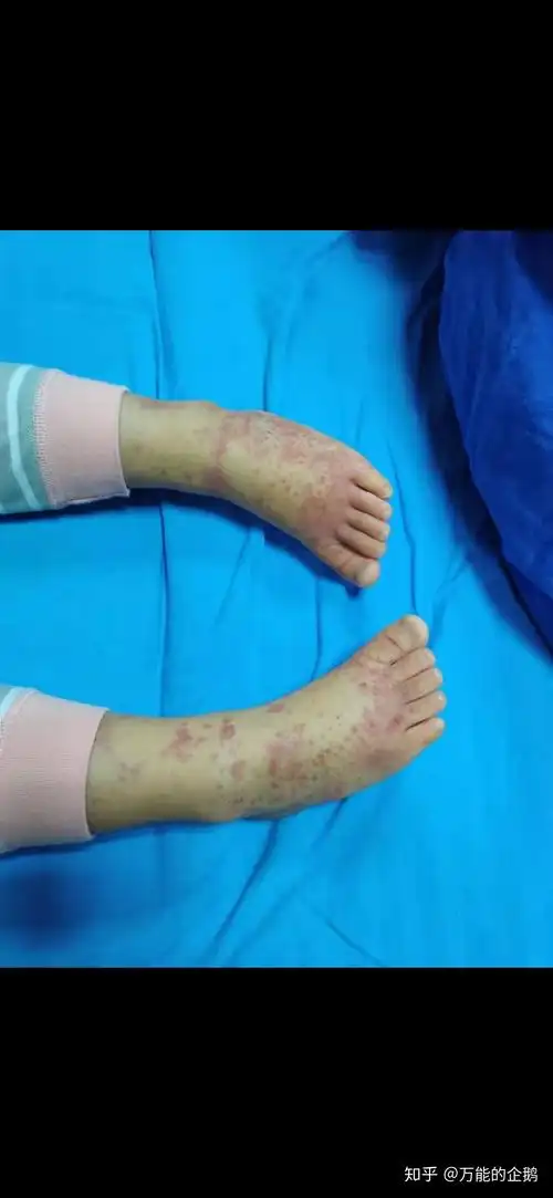 记录三岁宝贝女儿的过敏性紫癜之路1