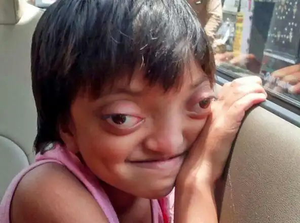 七岁女孩患上"青蛙眼"可令人傻眼的是很多家长向女孩订婚要娶她