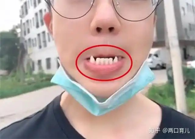 17岁男孩长尖牙妈妈吐槽吸血鬼网友被咬一口很难辨别