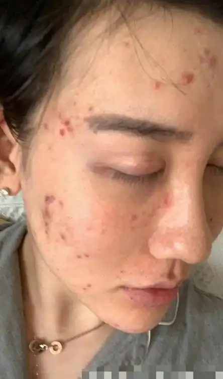 整容变毁容:网红百万整成女鬼,女星头顶整出大洞,简直惨不忍睹