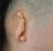 妈妈,我没有耳朵--先天性小耳畸形那点事