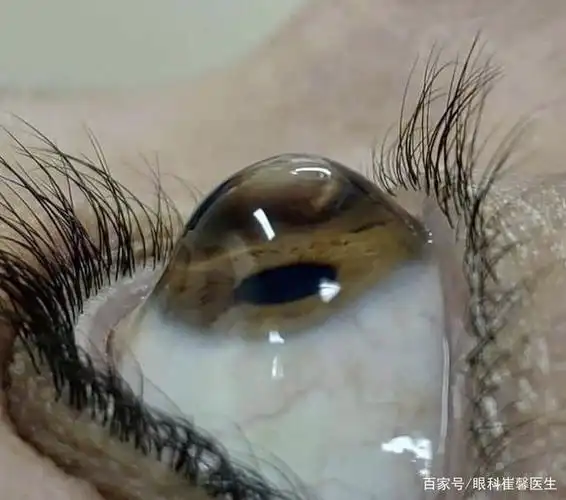 近视激光手术最可怕的后遗症是什么?不做好术前检查有多可怕?