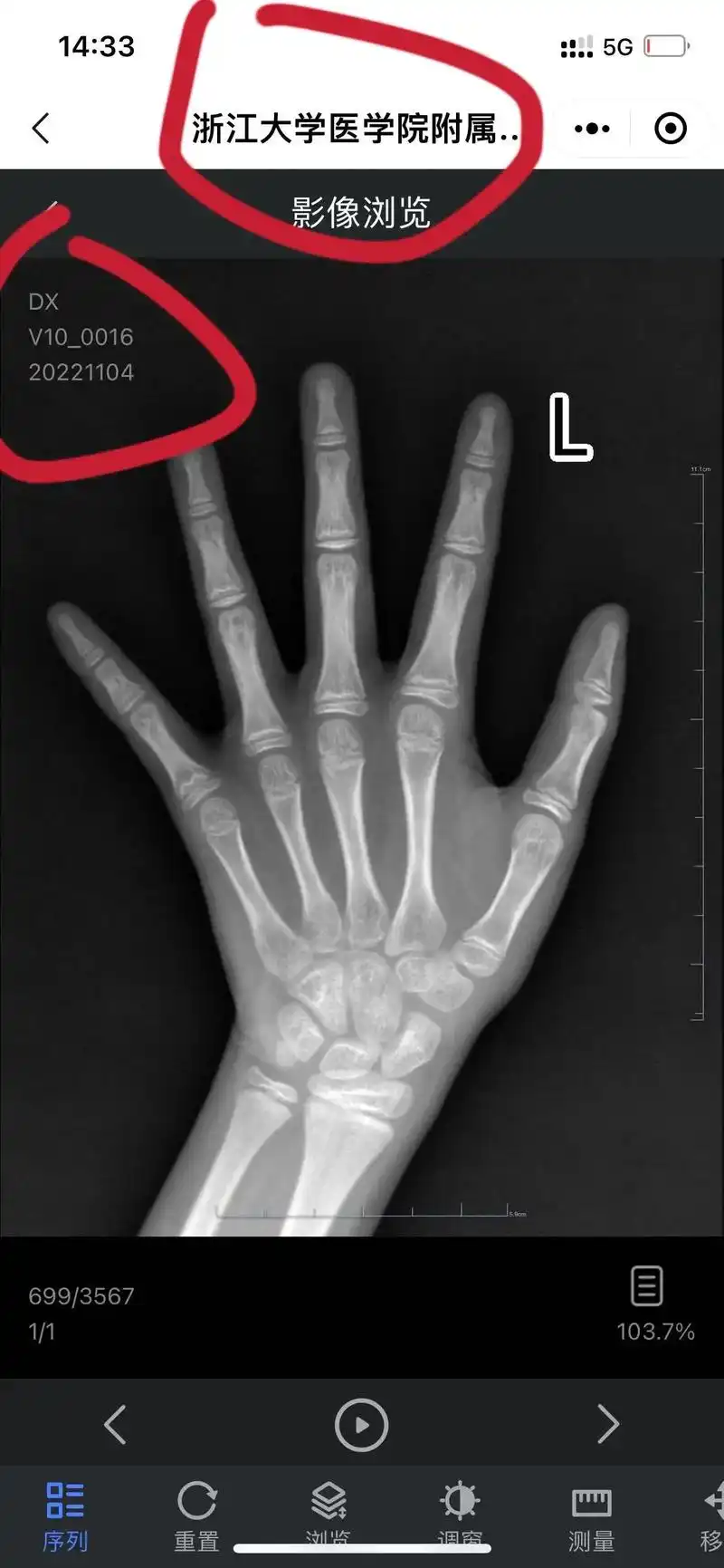 中华05积分法.浙大毕业的朋友 昨天在省儿保给孩子拍了骨龄片 - 抖音