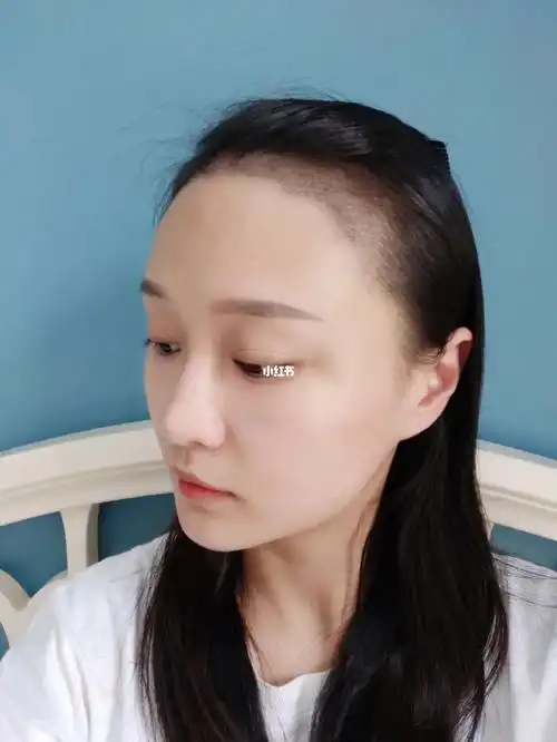 鼓起勇气做了植发,今天刚好第七天