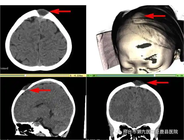 利用3d slicer导入头颅ct,vr重建头颅模型可见头发下隆起的头皮肿物