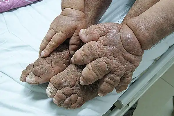 渝男子手脚橘皮样肿胀如熊掌