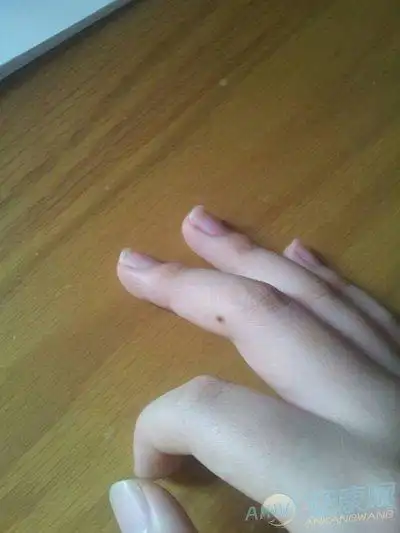 相学女人右手中指长痣代表什么?