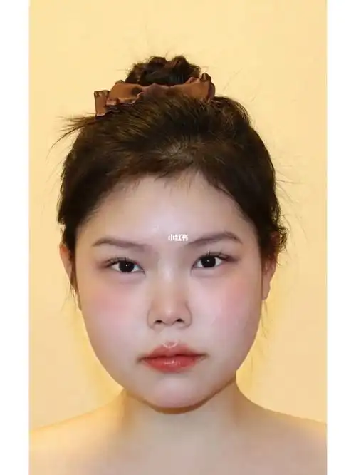 全切开扇型双眼皮47天