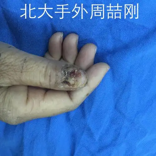 甲下黑线甲下黑色素瘤