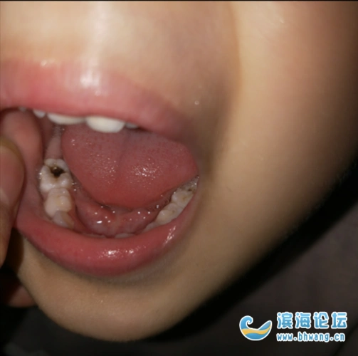 哪里给孩子看牙齿好点的啊我家孩子大牙齿蛀黑了