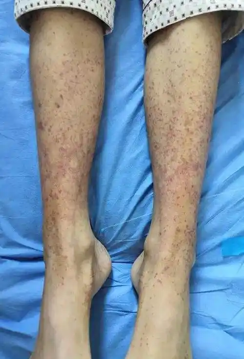 紫癜初期的图片(婴儿紫癜初期的图片)