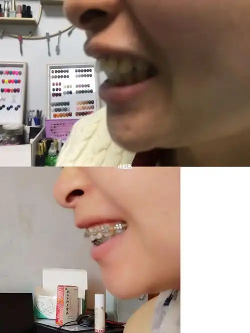 带牙套10个月的牙齿前后变化
